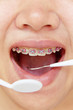 orthodontics,dental concept