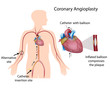 Coronary angioplasty, eps10