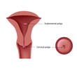 Cervical and endometrial polyps, eps8