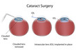 Cataract surgery , eps10