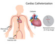 Cardiac catheterization, eps10
