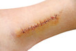 Stitches in the leg (ankle)