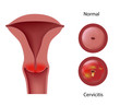 Cervicitis, eps8