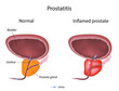 Prostatitis, eps10