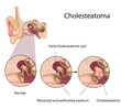 Cholesteatoma, eps10