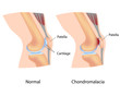 Chondromalacia, eps8