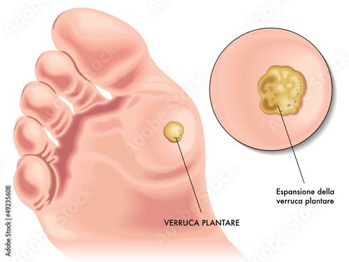 Vector: verruca plantare verruca plantare