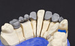 metal part of a dental bridge