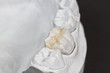dental onlay on a cast model
