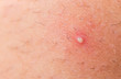ingrown hair closeup