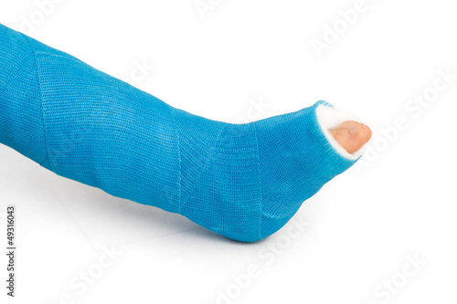 Photo: Bandaging of the broken leg with elastic bandage Bandaging of the broken leg with elastic bandage