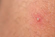 closeup of ingrown hair