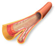 Arterienverkalkung