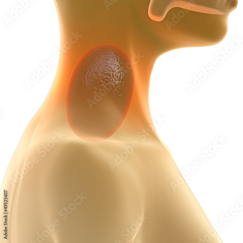 Illustration: Halsschmerzen - 3D Render Halsschmerzen - 3D Render