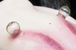 fire cupping treatment to cup sb therapy woman