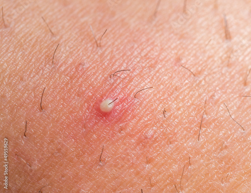 Photo: ingrown hair ingrown hair