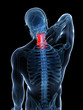 3d rendered illustration - painful neck