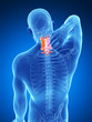 3d rendered illustration - painful neck
