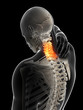 3d rendered illustration - painful neck
