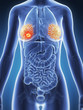 3d rendered illustration - breast cancer