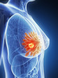3d rendered illustration - breast cancer