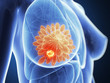 3d rendered illustration - breast cancer
