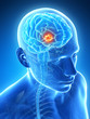 3d rendered illustration - brain tumor