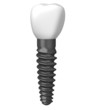 tooth implant