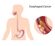 Esophageal cancer , eps10