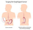 Surgery for treatment of esophageal cancer, eps8