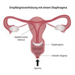 Empfängnisverhütung mit Diaphragma