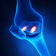 Knee Arthritis