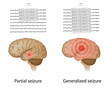EEG in partial and generalized epilepsy, eps10