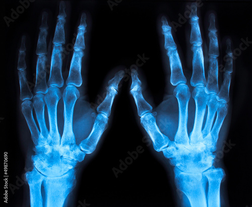 Photo: x-ray of an hand (blue) x-ray of an hand (blue)