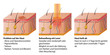 laser behandlung der haut