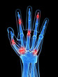 3d rendered illustration of painful finger joints