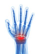 3d rendered illustration of the carpal tunnel syndrome