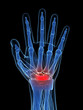 3d rendered illustration of the carpal tunnel syndrome