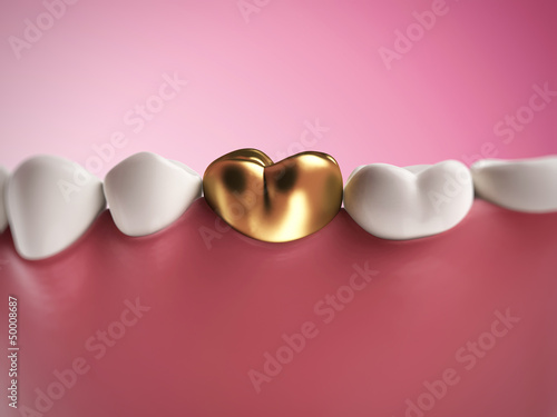 Illustration: 3d rendered illustration of a golden tooth 3d rendered illustration of a golden tooth