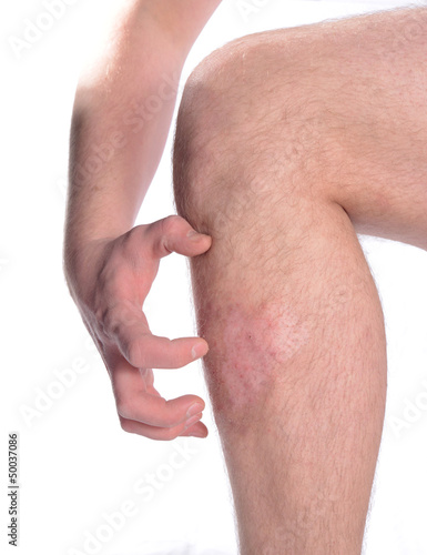 Photo: Itchy Skin? Itchy Skin?