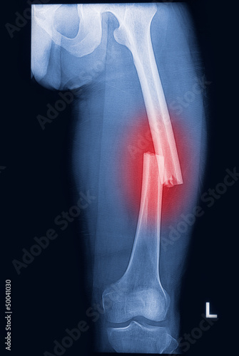 Photo: Broken human thigh x-rays image Broken human thigh x-rays image