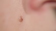 Macro shot of mole on human skin.