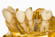 Foto: Zahnersatz - Implantate Zahnersatz - Implantate