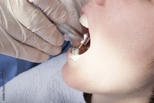 Photo: Dental Cleaning Close-up Dental Cleaning Close-up