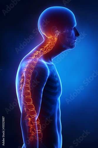 Illustration: Kyphotic spine lateral view in x-ray Kyphotic spine lateral view in x-ray