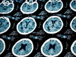 Computed tomography of human brain