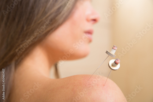 Photo: moxibustion acupunture needles heat on woman moxibustion acupunture needles heat on woman