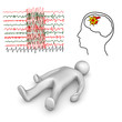 Apoplectic And Epileptic Stroke