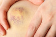 Bruised knee of a woman