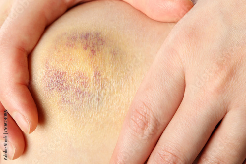 Photo: Bruised knee of a woman Bruised knee of a woman